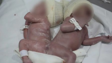 Gêmeos nascem unidos pela coluna em caso médico raro
