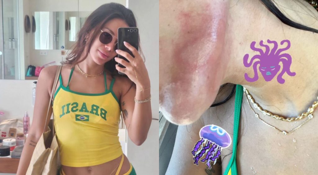 Anitta sofre queimadura por água-viva; 