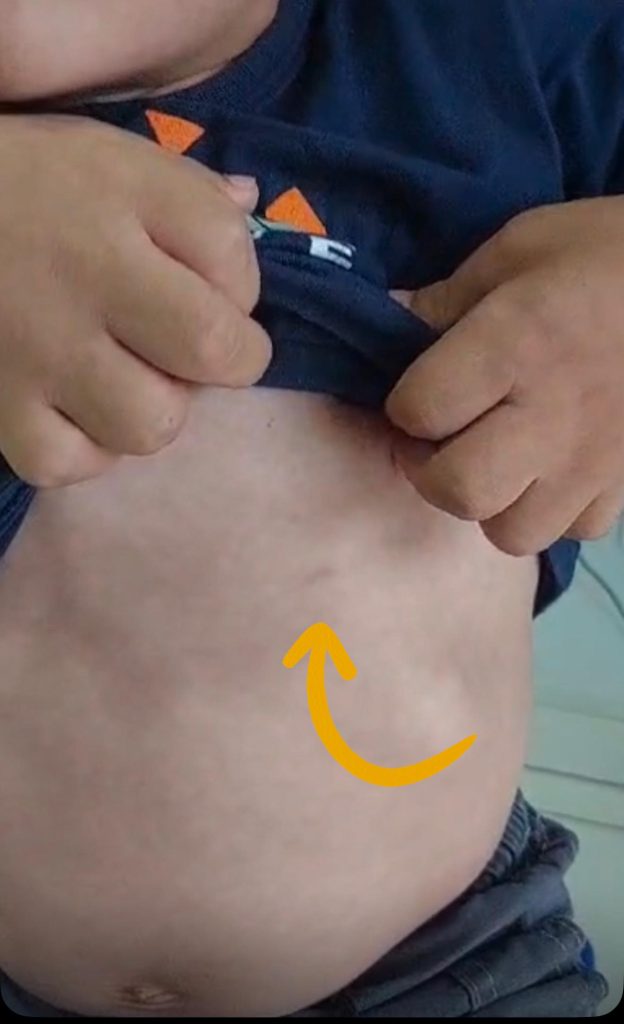 a person's stomach with a drawing of a smileCriança é atingida por disparo de arma de gel enquanto andava de bicicleta em Araponguinhas