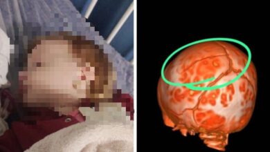 Bebê sofre fratura na cabeça após cair de trocador em creche de SC