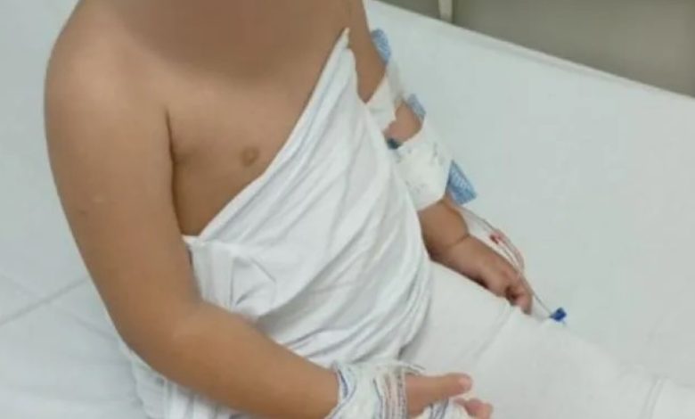 Menina de dois anos é queimada pela madrasta dentro de casa em Itajaí
