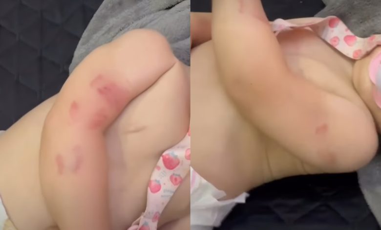 Bebê de 10 meses deixa creche com mordidas, hematomas e arranhões e levanta suspeita de negligência em Itajaí