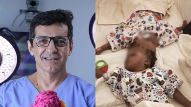 Com participação de neurocirurgião brasileiro, gêmeas siamesas unidas pelo crânio são separadas com sucesso